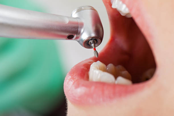 Best Emergency Wisdom Tooth Extraction in Ogden, NC
